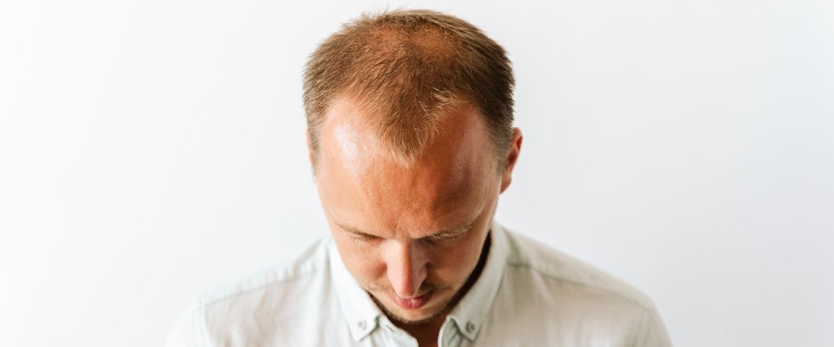 Saç Dökülmesi Tedavisi: Erkek Tipi ve Kadın Tipi Saç Dökülmesi